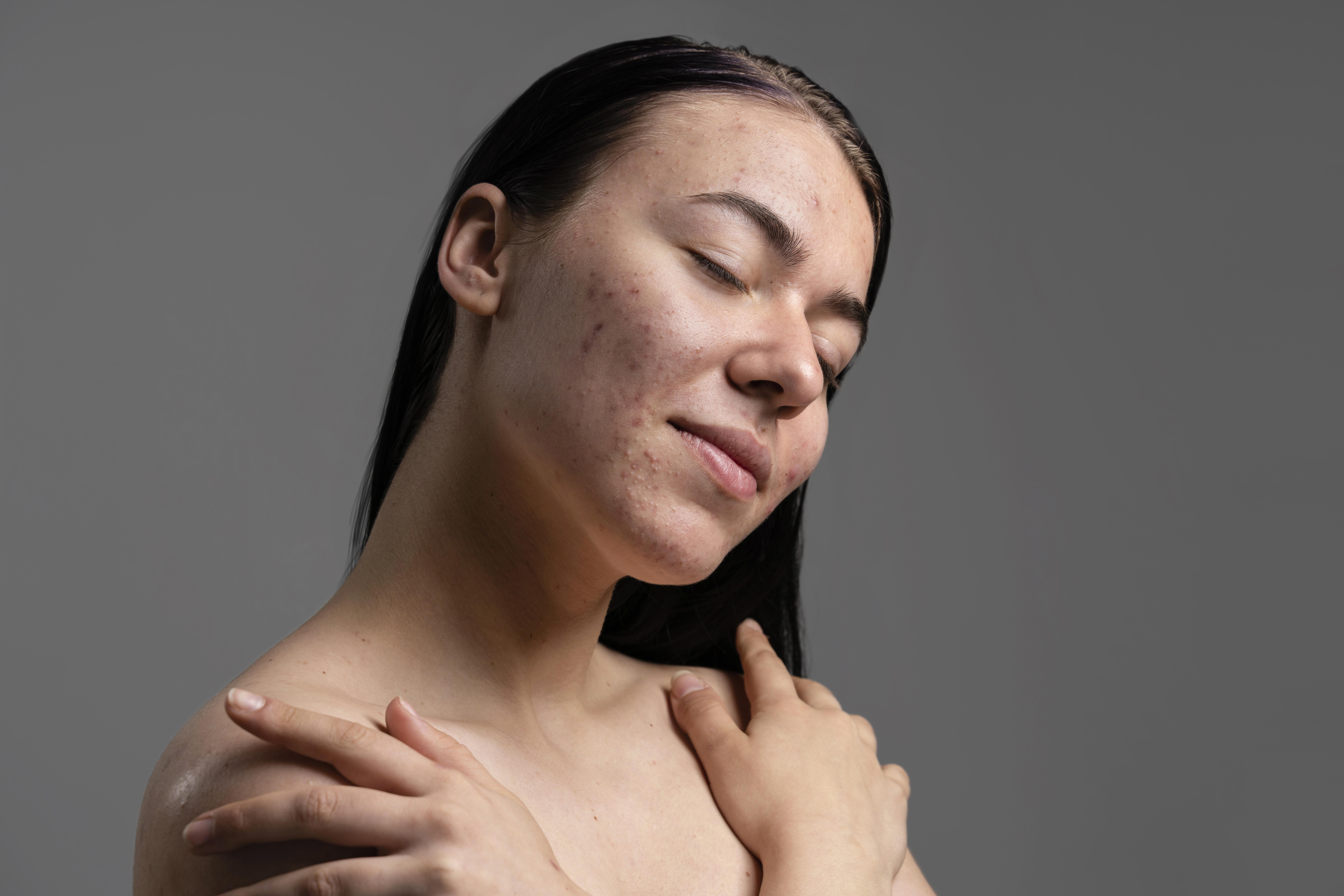 Desvende os mistérios da acne hormonal e descubra estratégias eficazes para combatê-la. Um guia completo para uma pele mais saudável e clara!