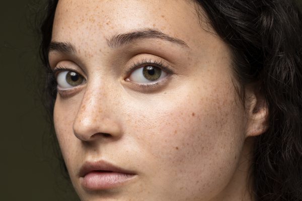 Explore os três tipos de melasma - epidérmico, dérmico e misto - e entenda as diferenças entre eles para um diagnóstico e tratamento mais eficazes.