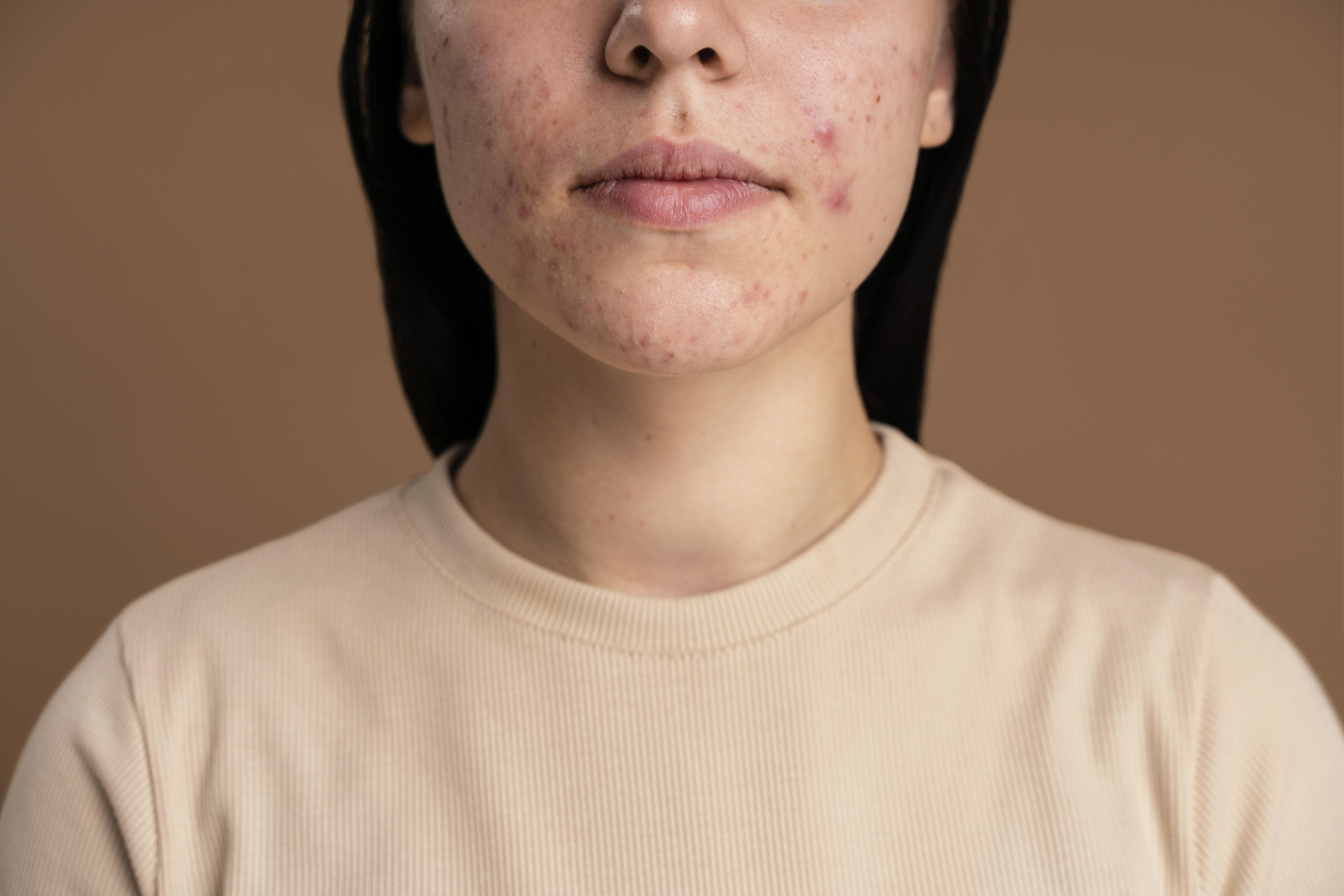 Descubra como o Óleo de Copaíba para tratar a acne pode ser um aliado poderoso para sua pele. Leia nosso guia completo e transforme sua rotina de cuidados!