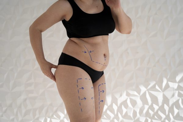 Descubra o poder transformador do Mommy Makeover, um conjunto de procedimentos cirúrgicos projetados para restaurar a autoestima e o contorno corporal das mães. Saiba como mamoplastias, mastopexia, lipoescultura e abdominoplastia podem colaborar para o bem-estar físico e emocional.