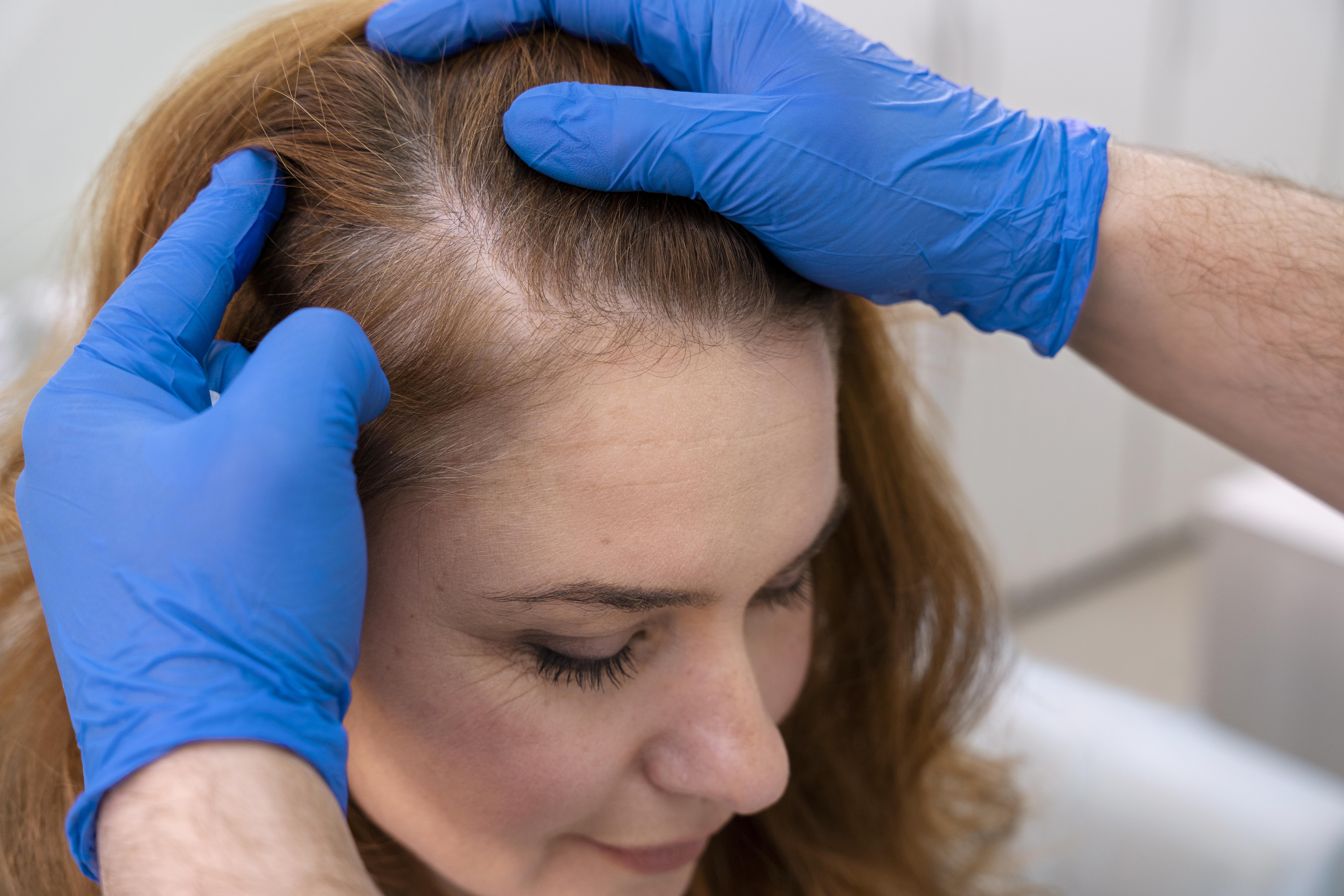 Descubra como a Espironolactona para queda de cabelo em mulheres oferece uma solução eficaz. Consulte um médico para iniciar seu caminho rumo a cabelos saudáveis.