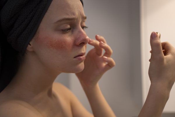 Entenda a Rosácea e como tratar as manchas vermelhas com nossas dicas de skincare. Descubra métodos eficazes para uma pele mais saudável e clara!
