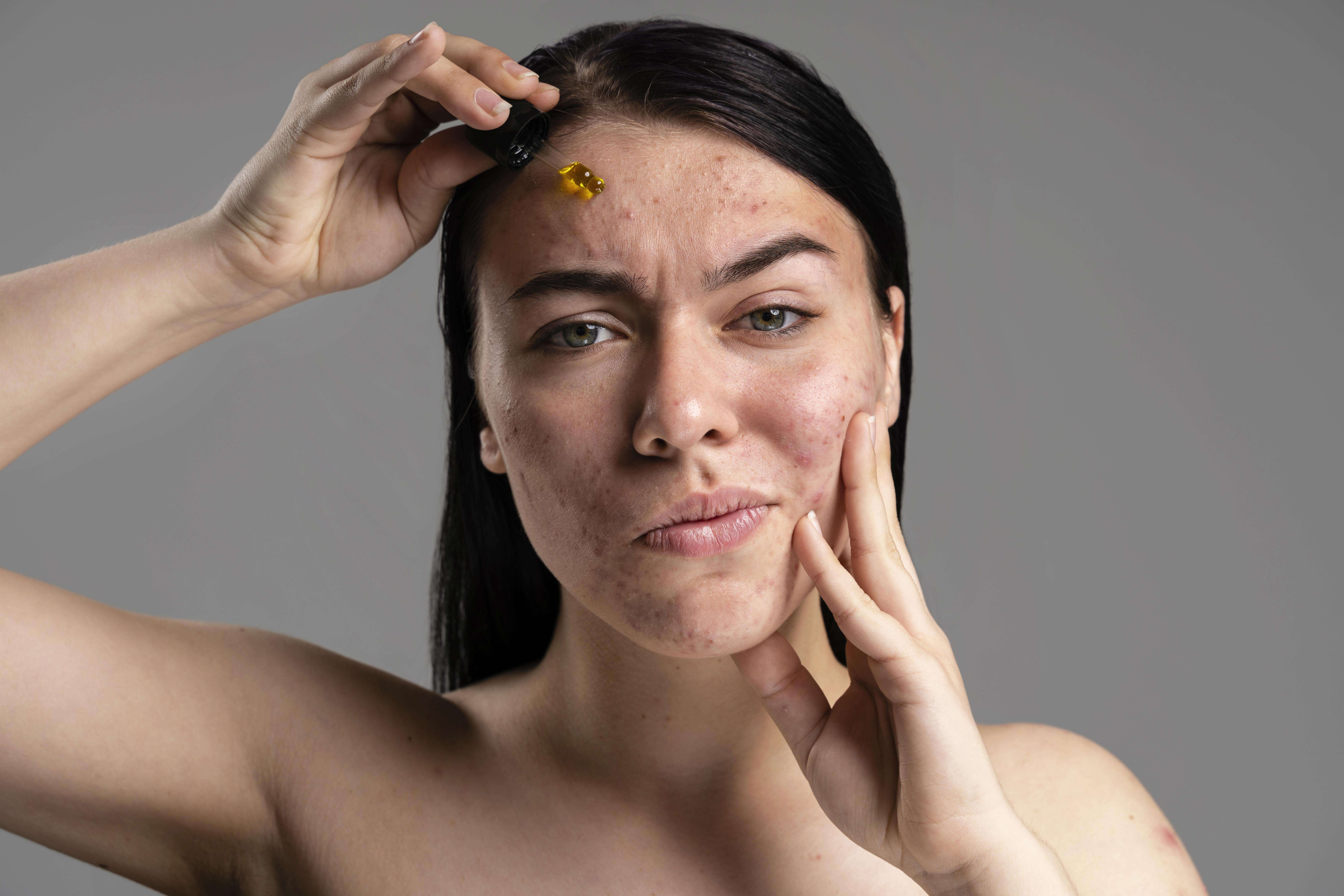 Imagem destacando produtos e ingredientes naturais usados no tratamento caseiro da acne.