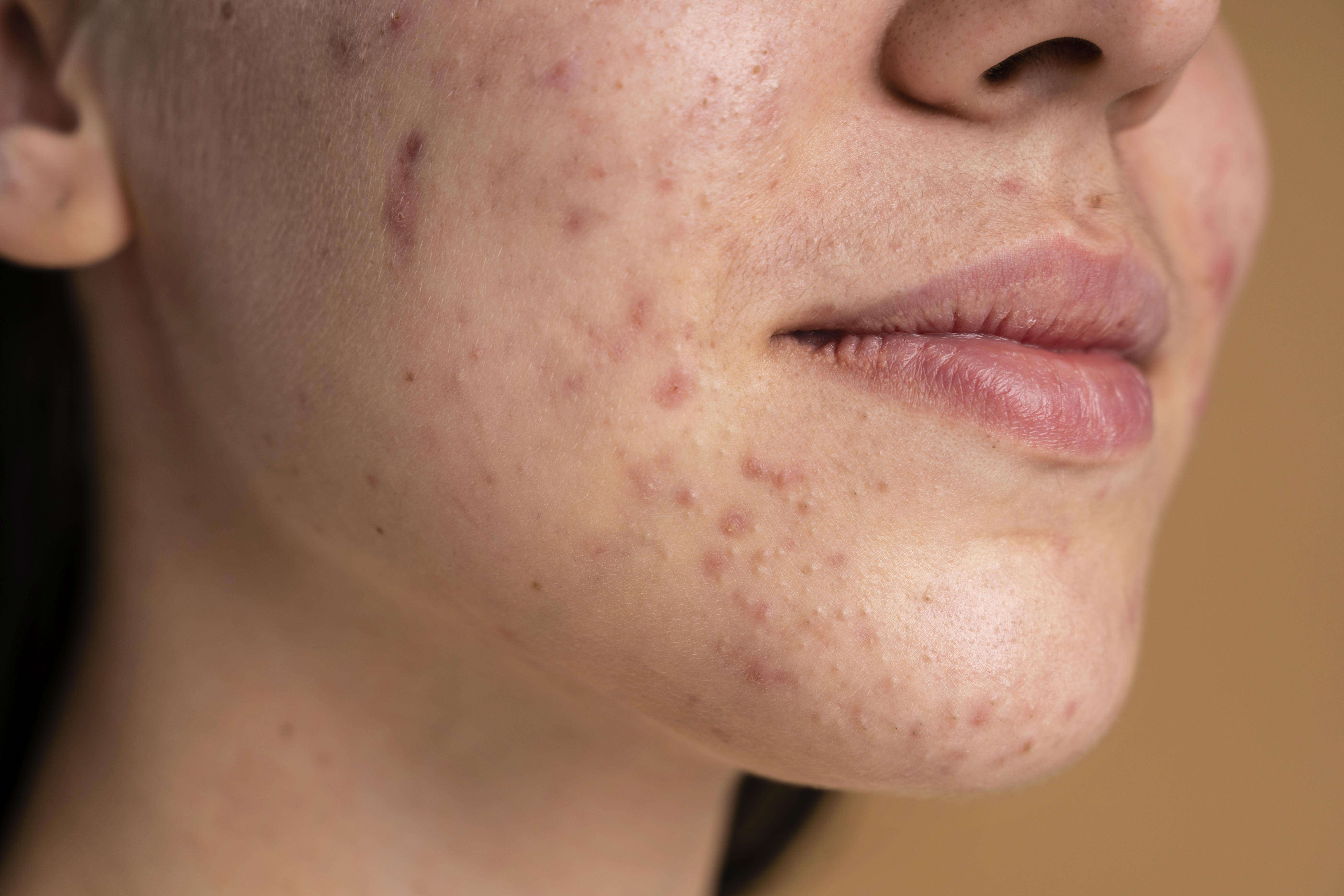 Explore a relação complexa entre hormônios e acne. Entenda como as flutuações hormonais podem provocar surtos de acne e descubra estratégias eficazes para controlar e prevenir essas erupções.