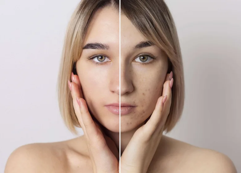 Acne: Causas, Tipos e Tratamentos Eficazes