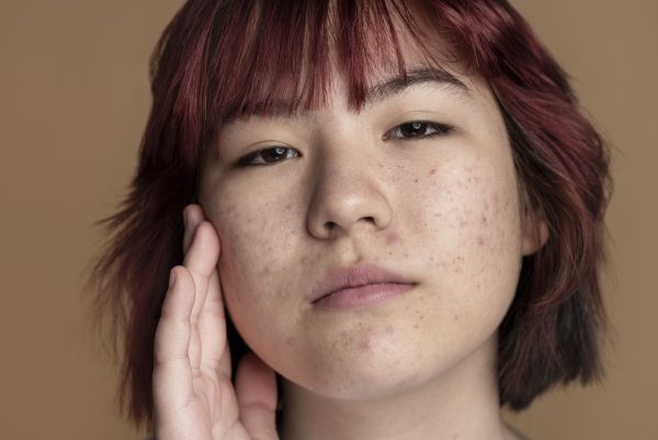 Anticoncepcional que ajuda na acne pode ser uma opção para pele mais limpa. Saiba quais tipos são eficazes e como usá-los corretamente aqui.