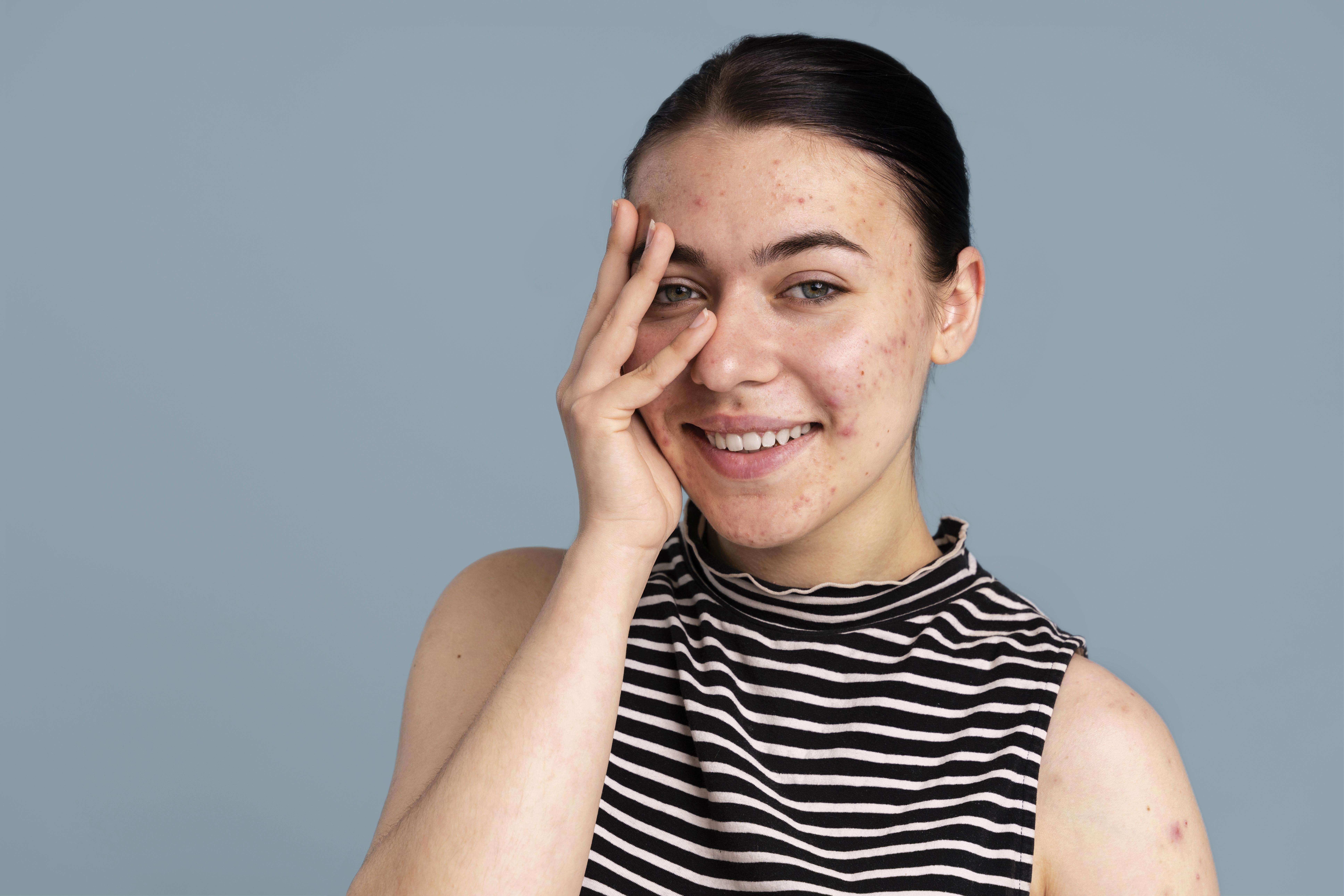 Imagem ilustrativa comparando Acne Fúngica e Acne Vulgar, mostrando características distintas de cada tipo para esclarecer diferenças.