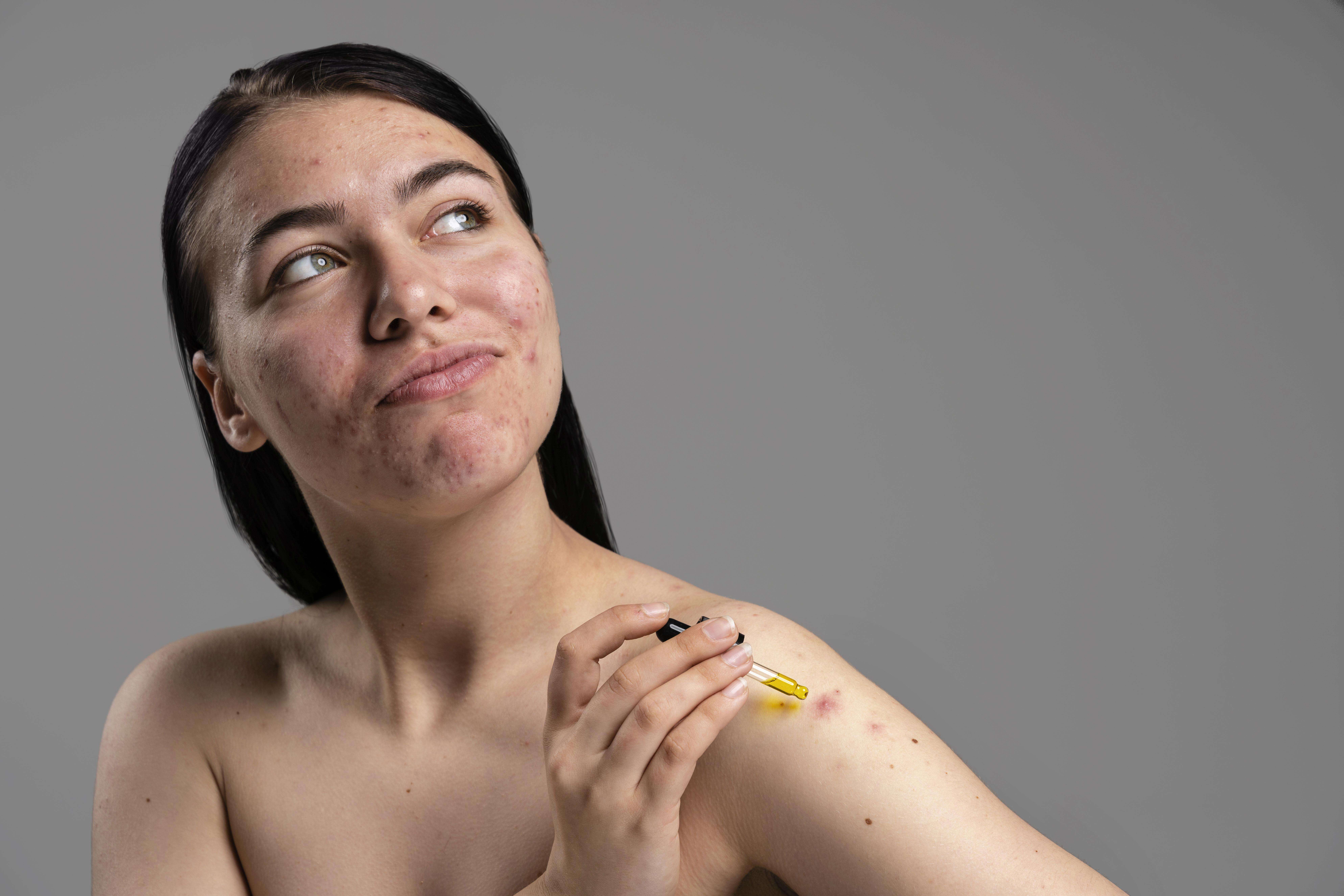 Leite de magnésia para acne: Mulher aplicando tratamento tópico no ombro, com foco no rosto que apresenta sinais de acne.