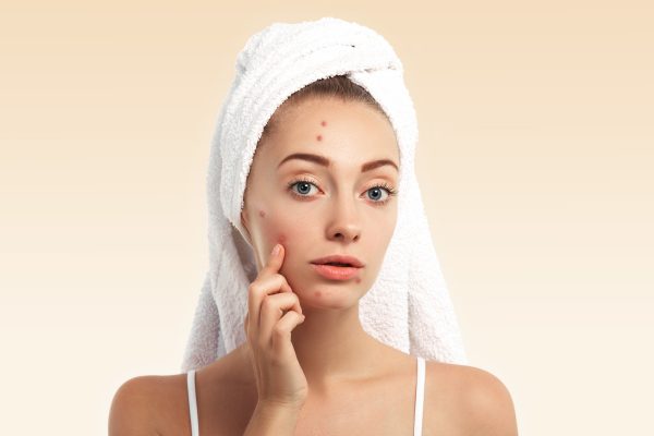 Guia completo sobre acne fúngica: definição, causas e tratamentos eficazes. Entenda como cuidar da sua pele e combater essa condição dermatológica.