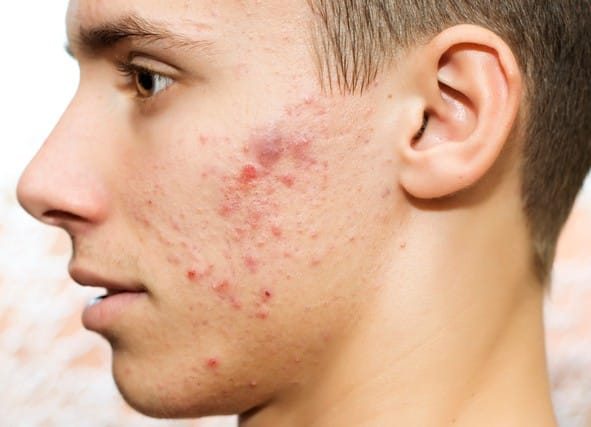 Acne nodular explicada: conheça as causas, tratamentos e dicas de prevenção para uma das formas mais severas de acne. Conquiste uma pele mais saudável.