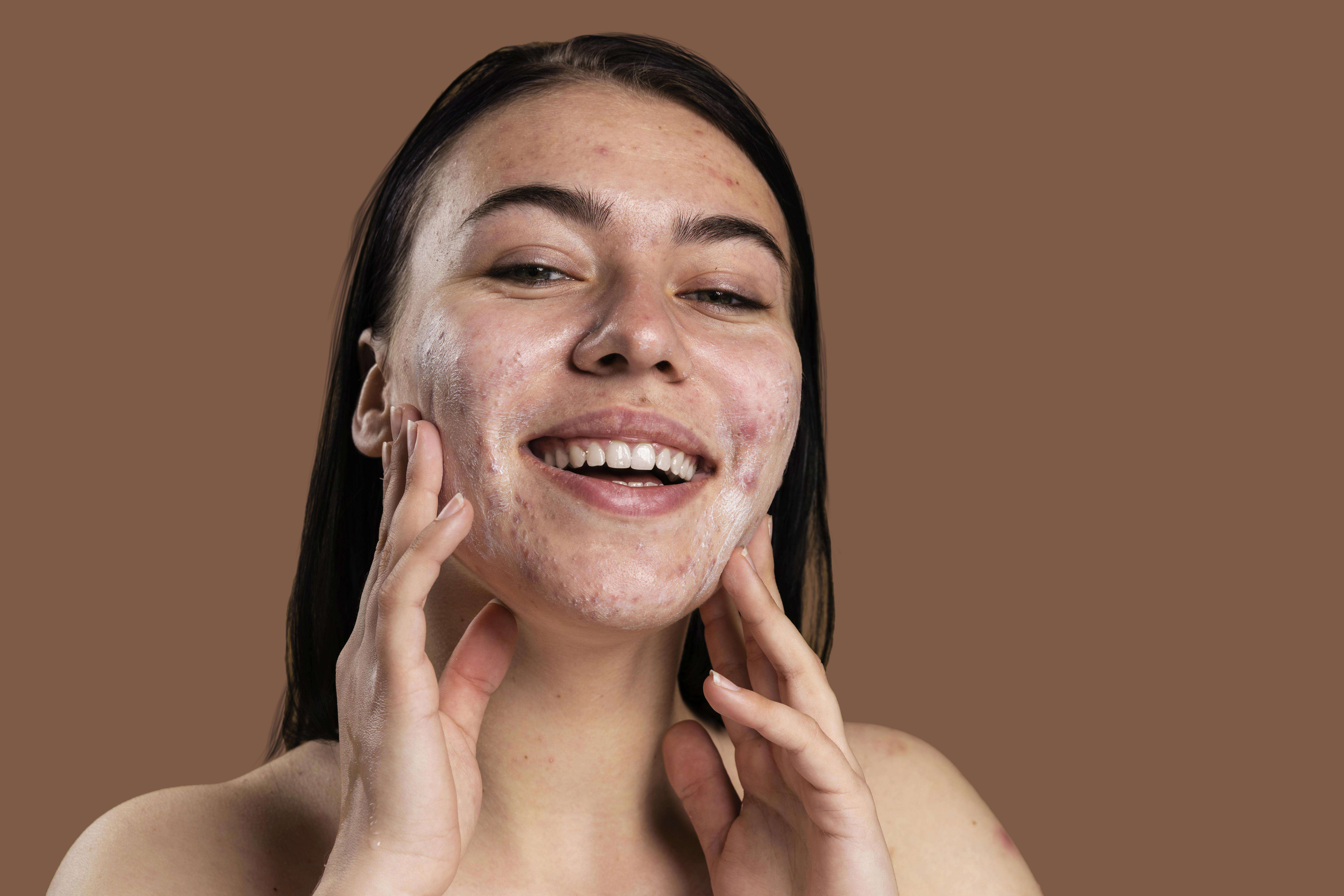 Descubra estratégias eficazes para tratar a acne grau 1, o estágio inicial da acne, incluindo dicas de cuidados com a pele e tratamentos recomendados para prevenir a progressão.