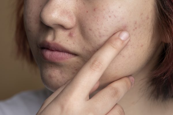Descubra estratégias eficazes para gerenciar acne interna, um tipo de acne que se forma sob a pele, causando dor e desconforto sem manifestações visíveis comuns.