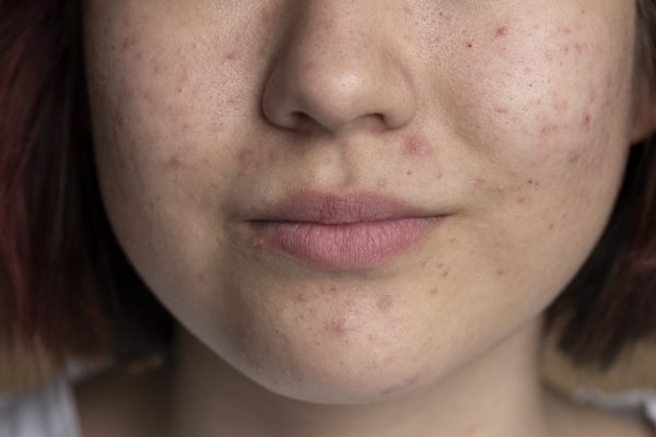 Descubra a duração típica de uma acne inflamada e conheça métodos para reduzir a inflamação e promover uma recuperação mais rápida da pele.