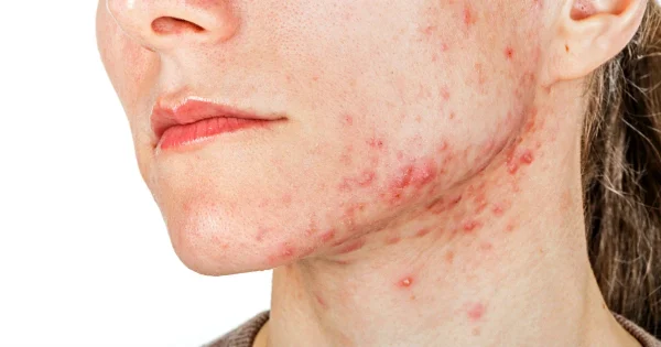 Vitamina B12 e Acne: Saiba mais sobre a relação entre essa vitamina essencial e a saúde da sua pele. Encontre o equilíbrio para uma pele radiante.