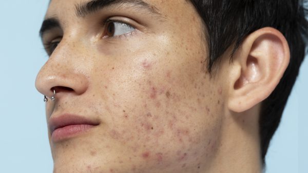 Conheça métodos comprovados para eliminar a acne, desde cuidados diários com a pele até alterações alimentares, e veja como melhorar a saúde da sua pele.