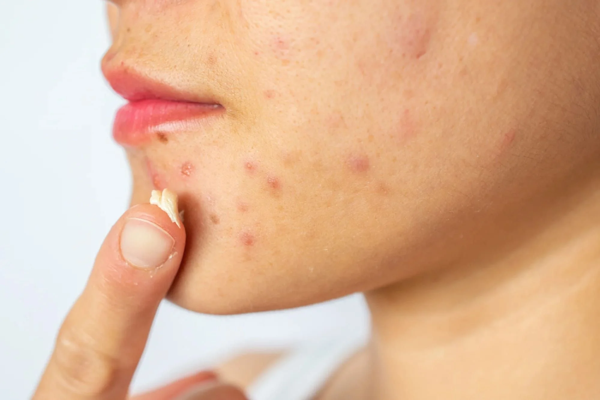Acne no queixo: entenda as causas e descubra tratamentos eficazes para lidar com esse problema comum de pele.