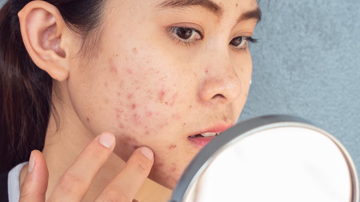 Acne no rosto: descubra as causas e aprenda estratégias eficazes para prevenir e tratar esse problema de pele comum.