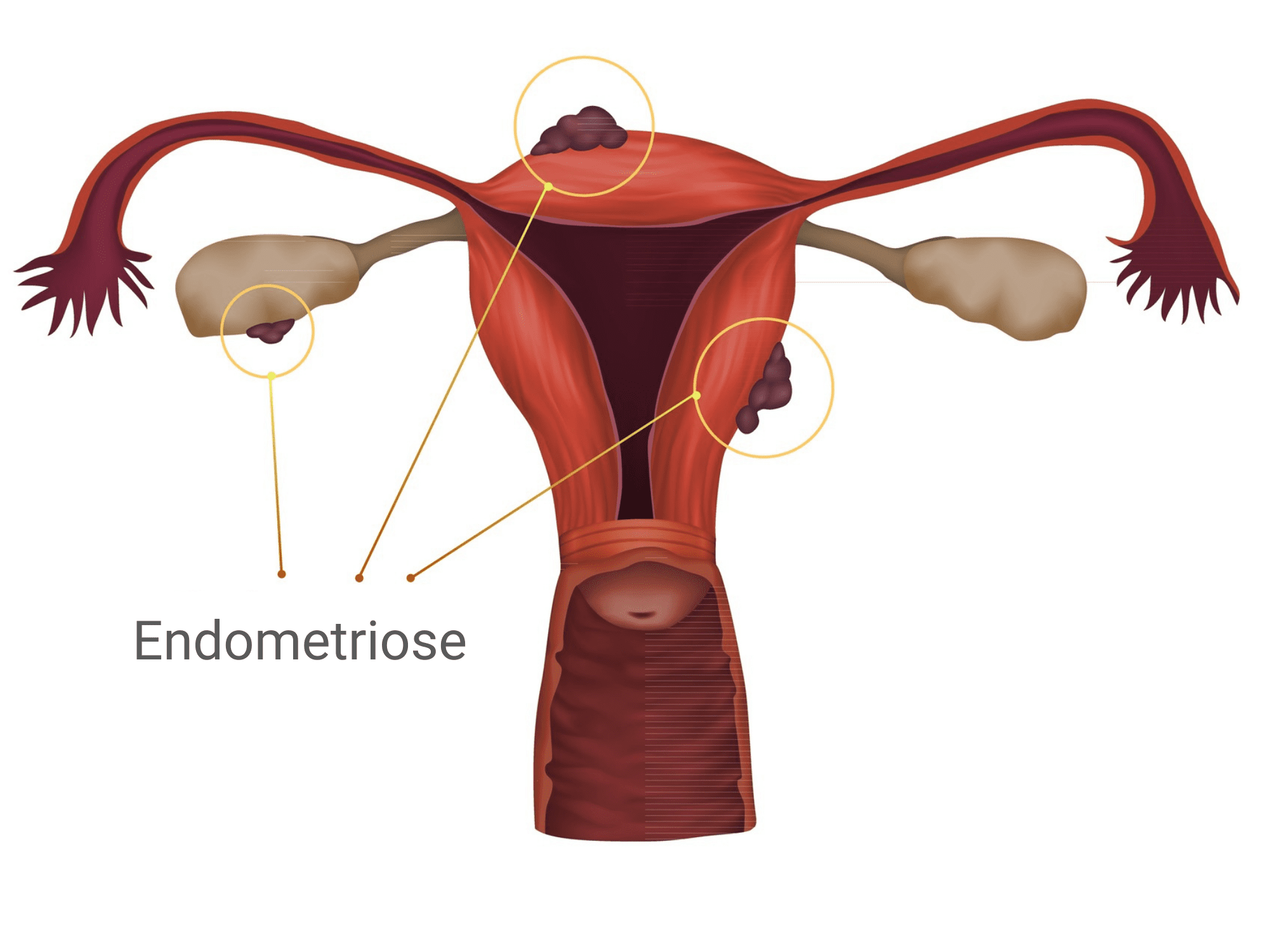 Endometriose sintomas: Descubra os principais sinais e sintomas da endometriose, incluindo dor pélvica intensa, problemas de fertilidade e mais. Informações essenciais para reconhecimento e tratamento.