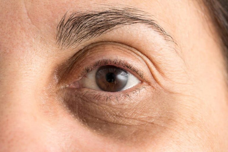 Descubra como clarear olheiras com métodos eficazes e tratamentos avançados. Saiba mais sobre as causas e explore soluções para revitalizar a área dos olhos.