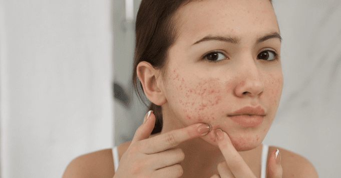 DIM para Acne Hormonal: Descubra como o DIM, encontrado em vegetais crucíferos, pode ser um aliado no tratamento da acne hormonal e na regulação do estrogênio.