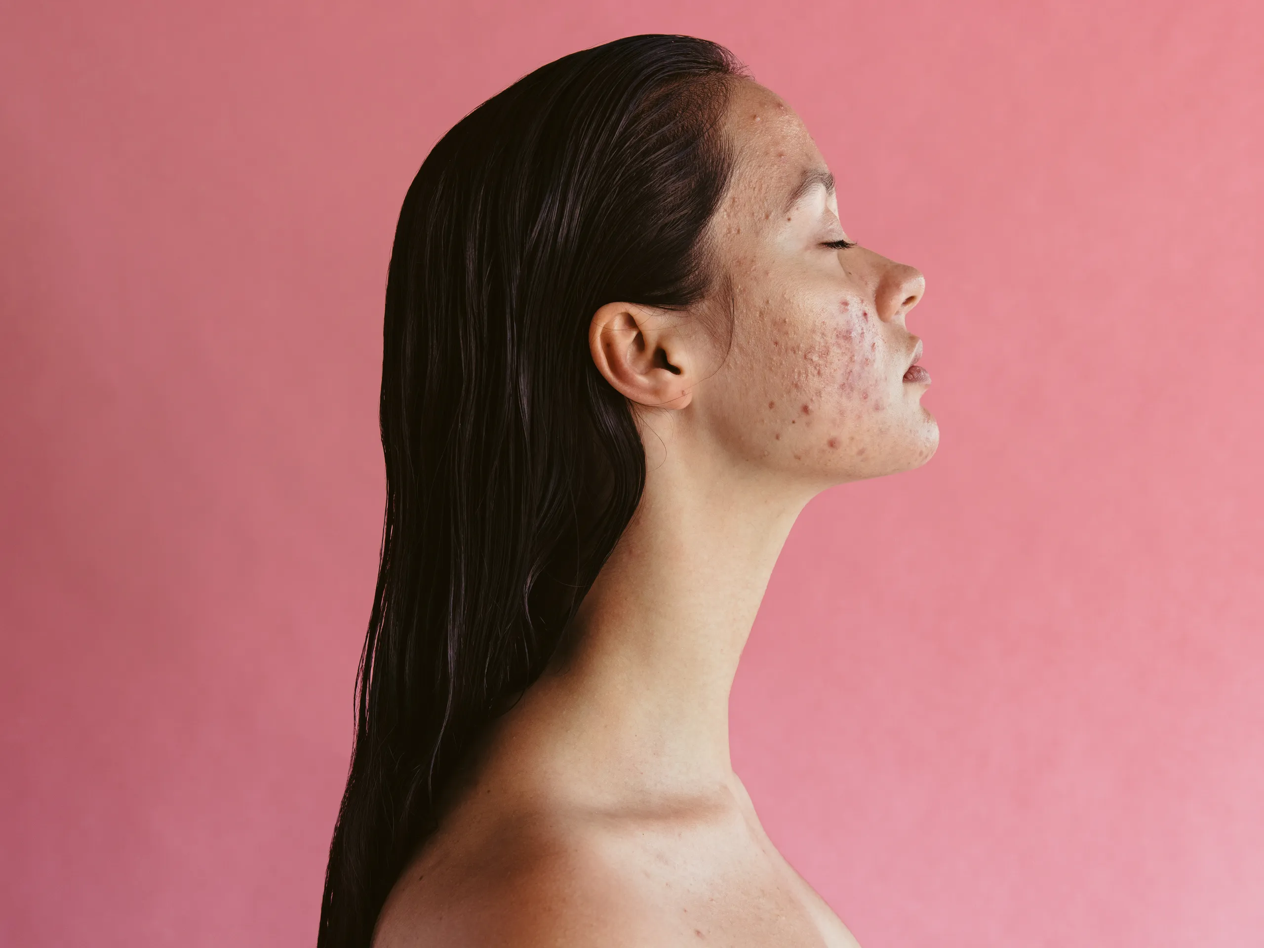 Saiba o que é acne hormonal, suas causas e como controlar esse incômodo persistente na vida adulta.