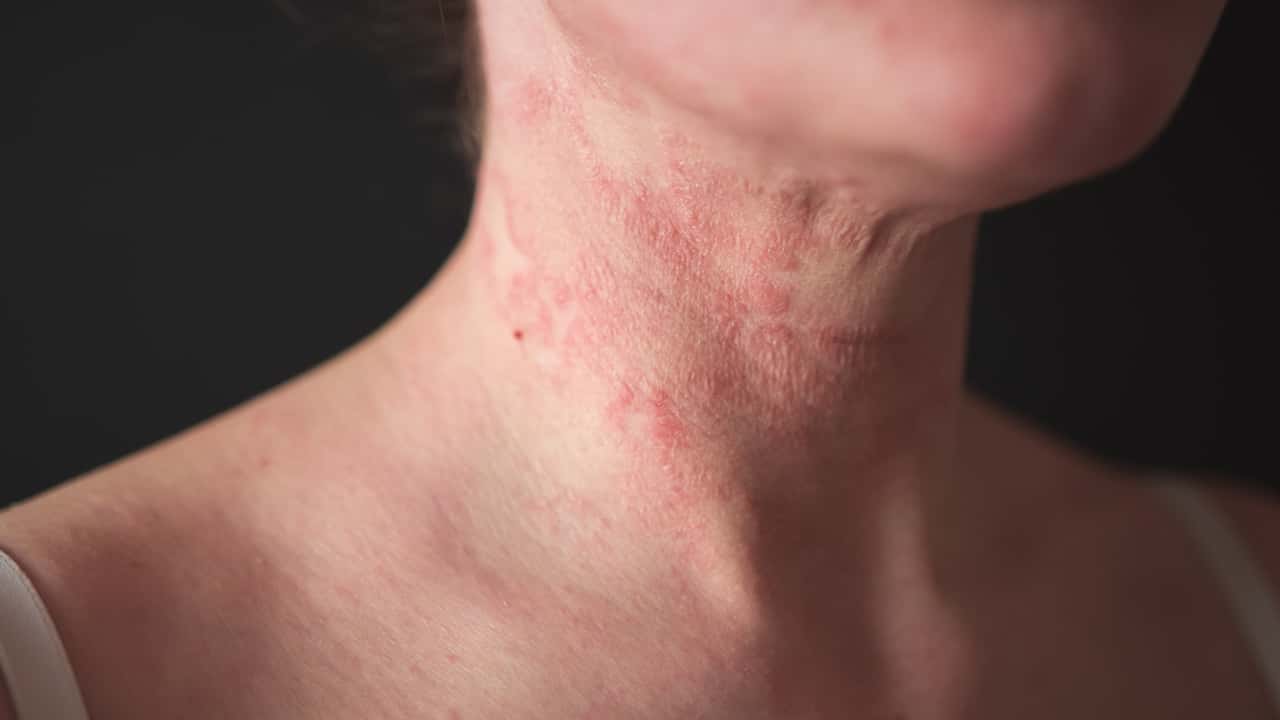 Descubra os principais tipos de inflamação na pele, incluindo sintomas, causas e tratamento para as dermatites mais comuns que afetam adultos e crianças.