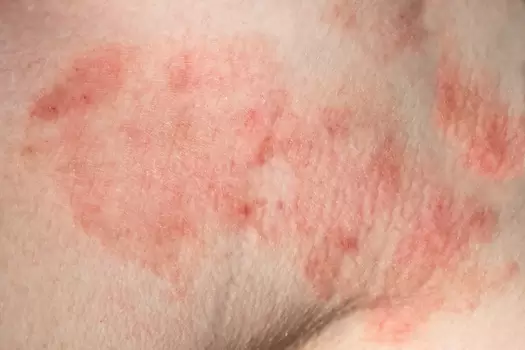 Descubra os principais tipos de inflamação na pele, incluindo sintomas, causas e tratamento para as dermatites mais comuns que afetam adultos e crianças.