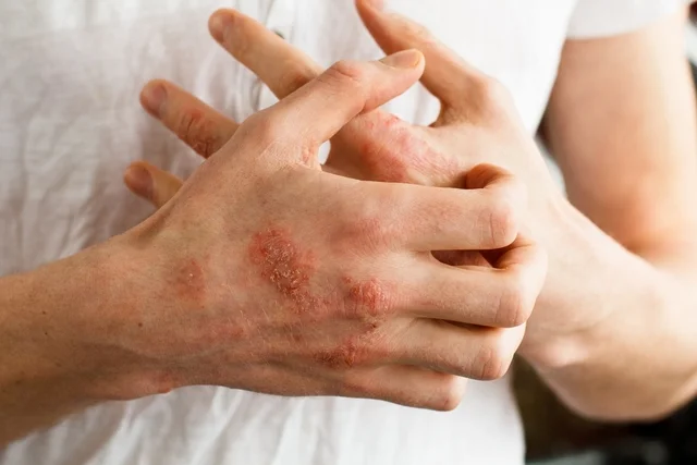Descubra os principais tipos de inflamação na pele, incluindo sintomas, causas e tratamento para as dermatites mais comuns que afetam adultos e crianças.