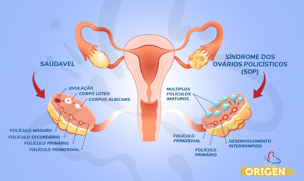 Hormônios Andrógenos Femininos: Descubra tudo sobre suas funções essenciais no corpo da mulher, e como eles influenciam a saúde.