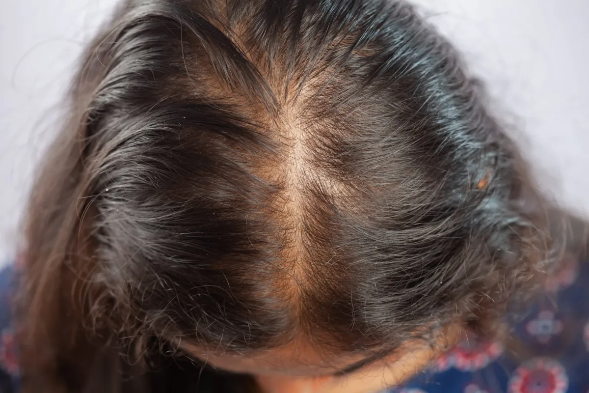 Alopecia: Guia Completo sobre Causas, Tipos e Tratamentos