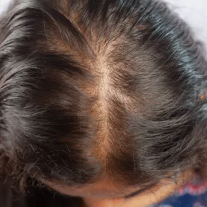 Alopecia: Guia Completo sobre Causas, Tipos e Tratamentos