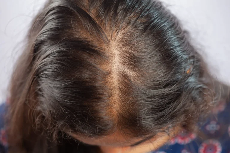 Alopecia: Guia Completo sobre Causas, Tipos e Tratamentos
