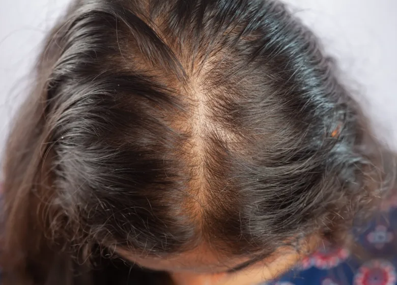 Alopecia: Guia Completo sobre Causas, Tipos e Tratamentos